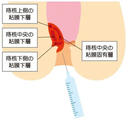 Phẫu thuật trĩ về trong ngày ở Nhật